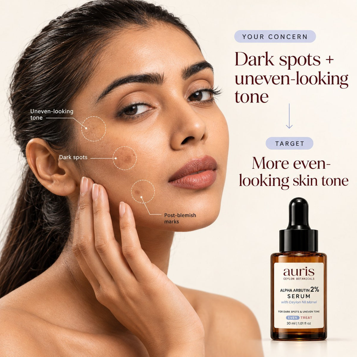 OLD (restored for review) — Model with dark spots, post-blemish marks and uneven-looking tone, alongside Auris EVEN Alpha Arbutin 2% Serum with Ceylon Nil Manel