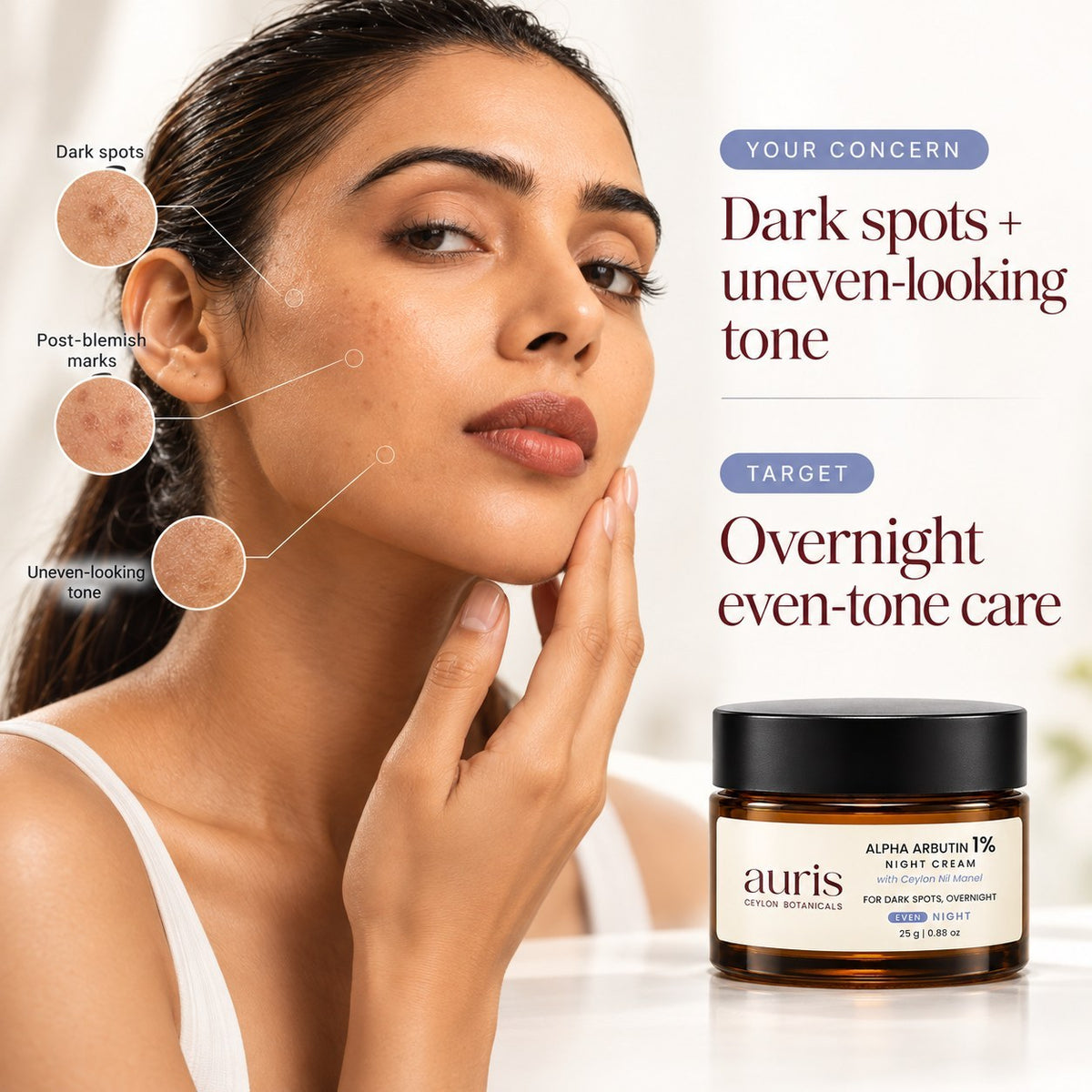 OLD (restored for review) — Model with dark spots, post-blemish marks and uneven-looking tone, alongside Auris EVEN Alpha Arbutin 1% Night Cream with Ceylon Nil Manel